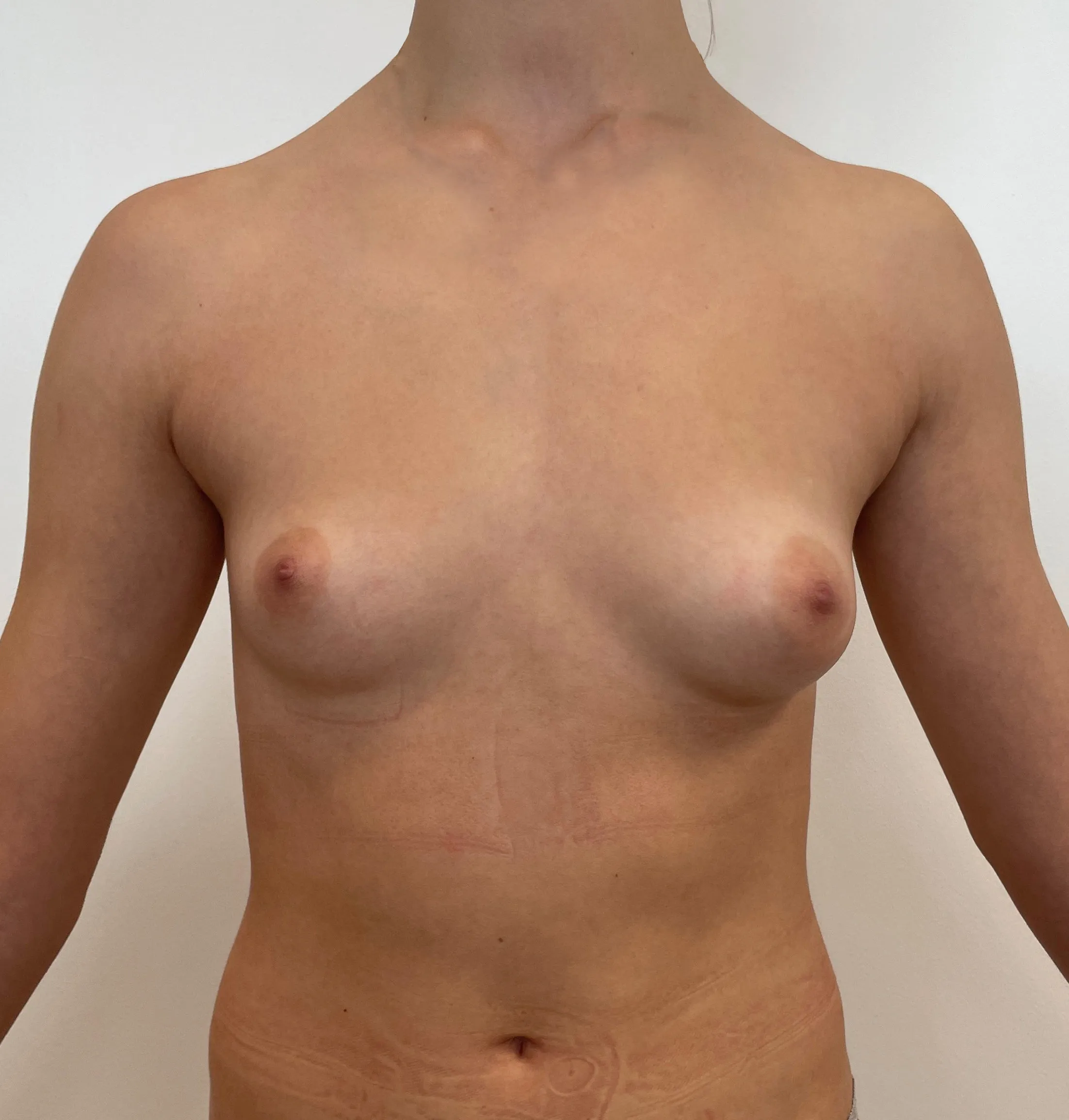 photo avant correction asymétrie des seins