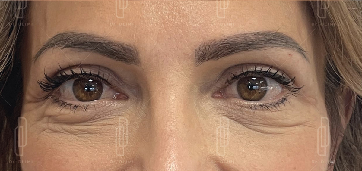blépharoplastie après intervention