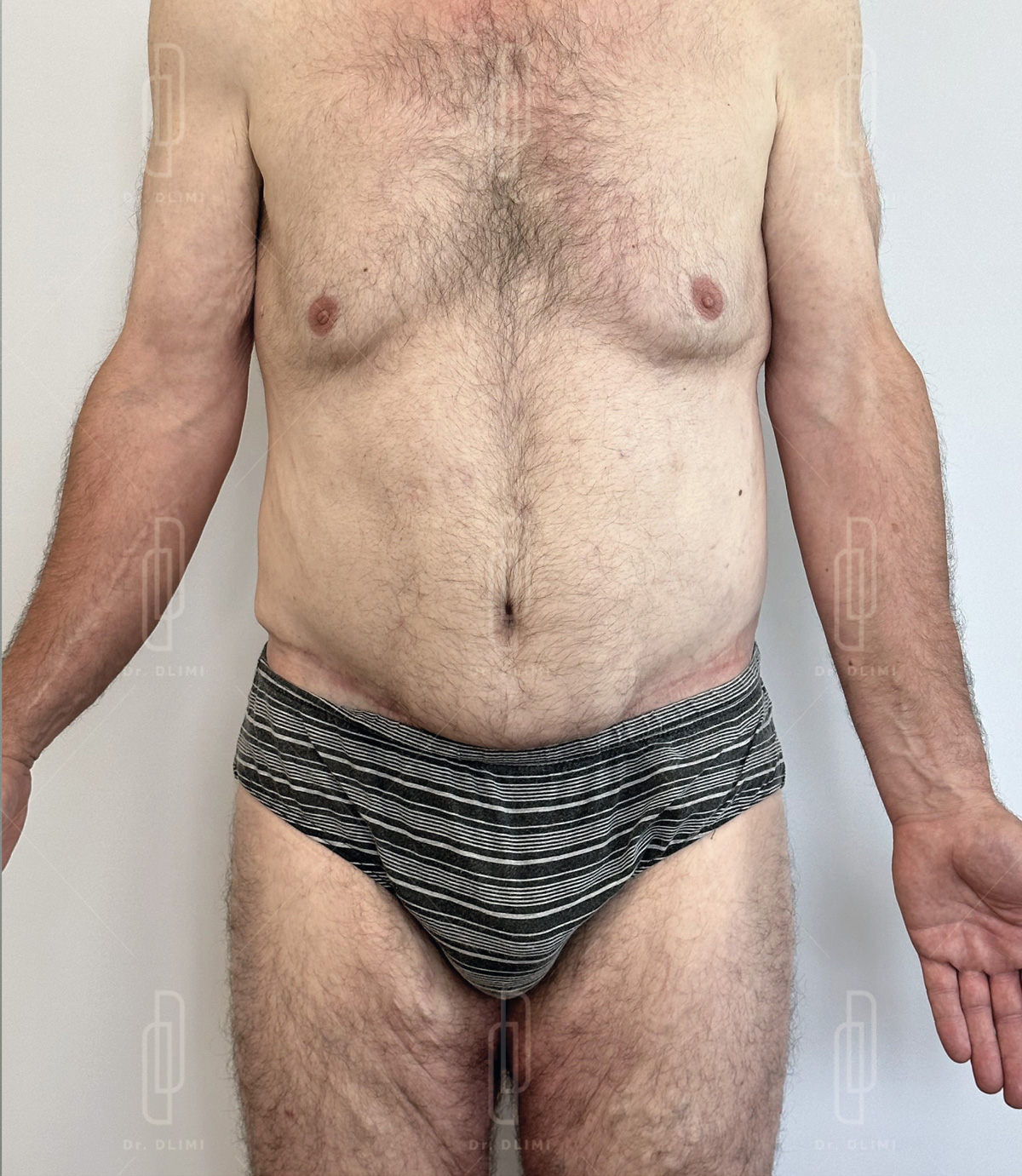 bodylift après intervention