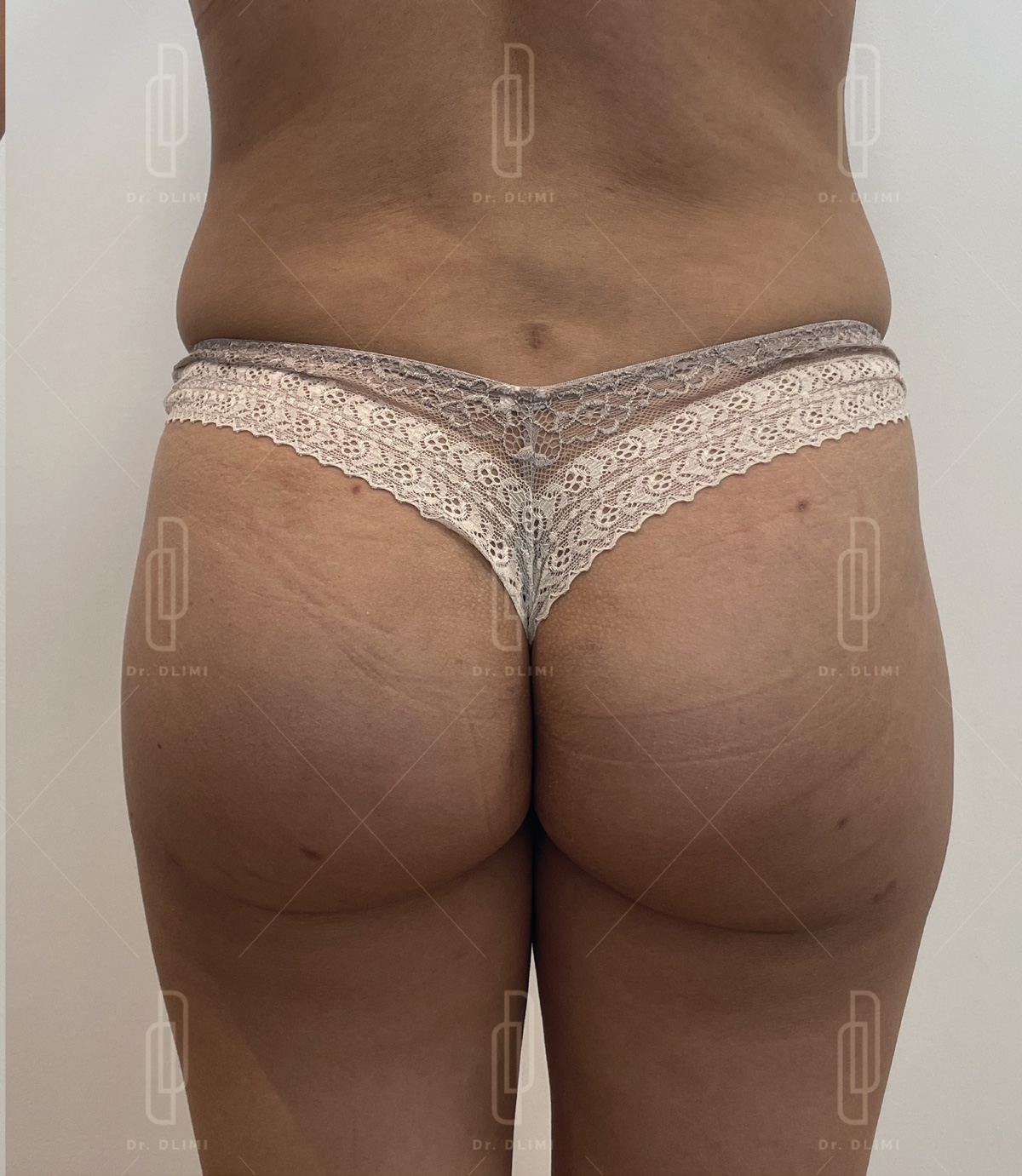 après intervention de prothèses de fesses
