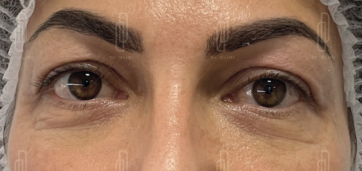 blépharoplastie avant intervention