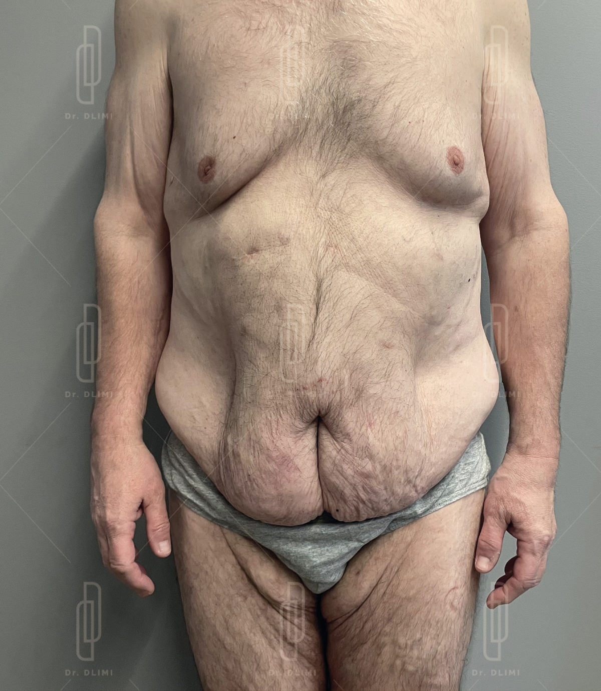 bodylift avant intervention