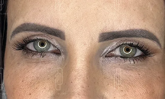 blépharoplastie après intervention