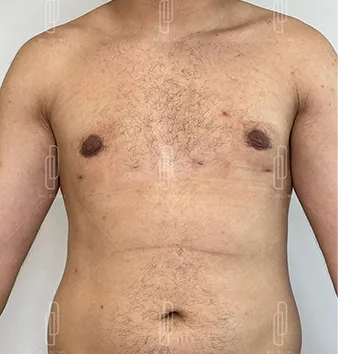 gynecomastie après intervention dr dlimi