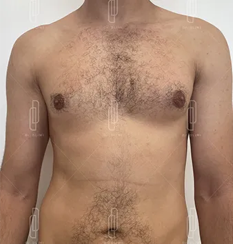 gynecomastie avant intervention dr dlimi