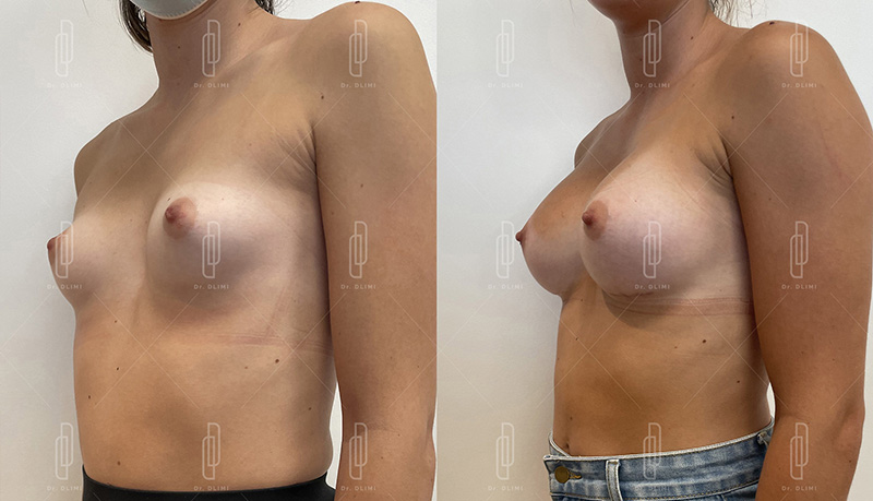 Augmentation mammaire composite à Lyon Dr Dlimi chirurgie esthétique