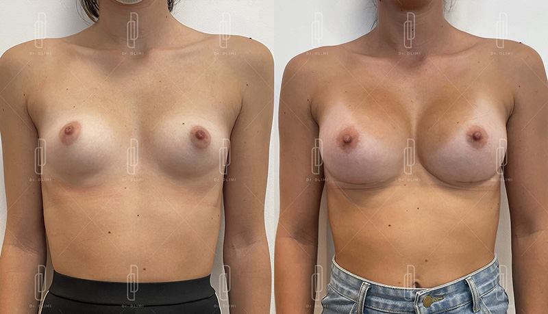 Augmentation mammaire composite à Lyon Dr Dlimi chirurgie esthétique