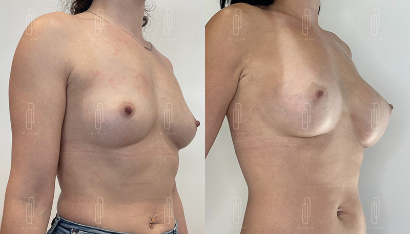 augmentation mammaire composite à Lyon Dr Dlimi chirurgien esthétique