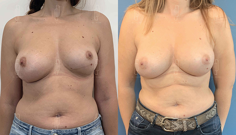 Augmentation mammaire par lipofilling à Lyon Dr Dlimi chirurgie esthétique