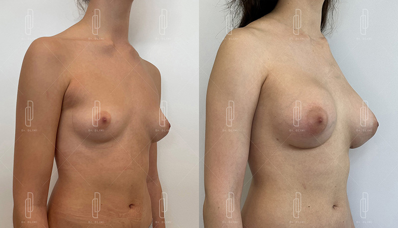 augmentation mammaire par prothèses à Lyon Dr Dlimii chirurgie esthétique