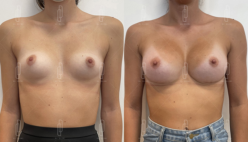 augmentation mammaire par prothèses à Lyon Dr Dlimi chirurgie esthétique