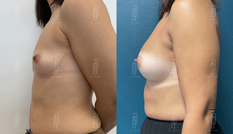 augmentation mammaire par prothèses à Lyon Dr Dlimi chirurgie esthétique