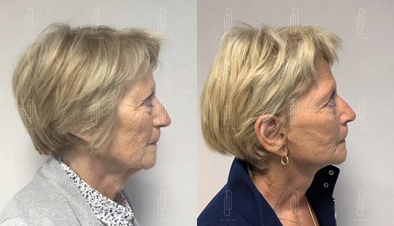 Lifting du visage à Lyon Dr Dlimi chirurgie esthétique