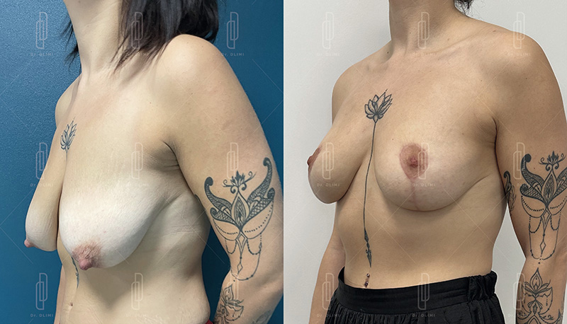 lifting mammaire à Lyon Dr Dlimi chirurgien esthétique