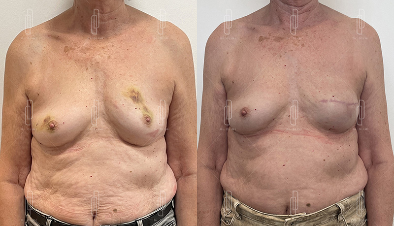 Reconstruction mammaire à Lyon Dr Dlimi chirurgien esthétique