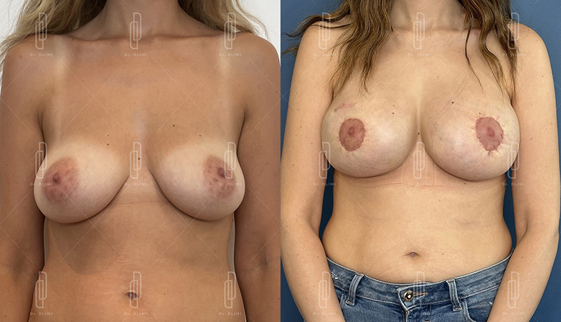 Reconstruction mammaire à Lyon Dr Dlimi chirurgien esthétique