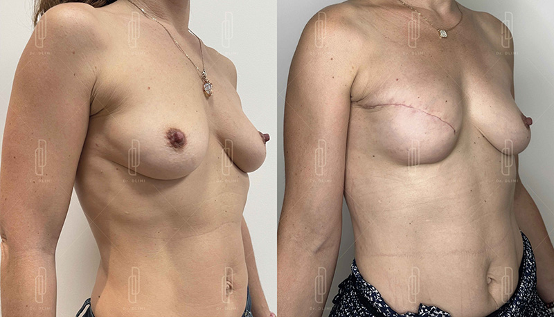 reconstruction mammaire à Lyon Dr Dlimi chirurgie réparatrice