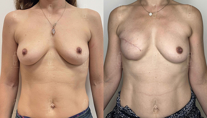 reconstruction mammaire à Lyon Dr Dlimi chirurgie réparatrice