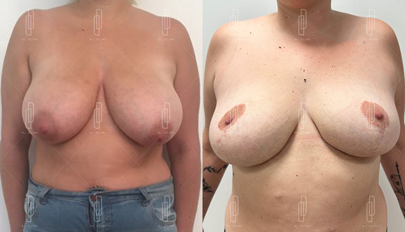 Réduction mammaire à Lyon Dr Dlimi chirurgien esthétique