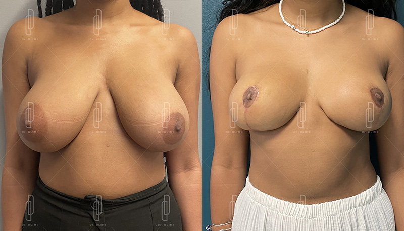 Réduction mammaire à Lyon Dr Dlimi chirurgien esthétique