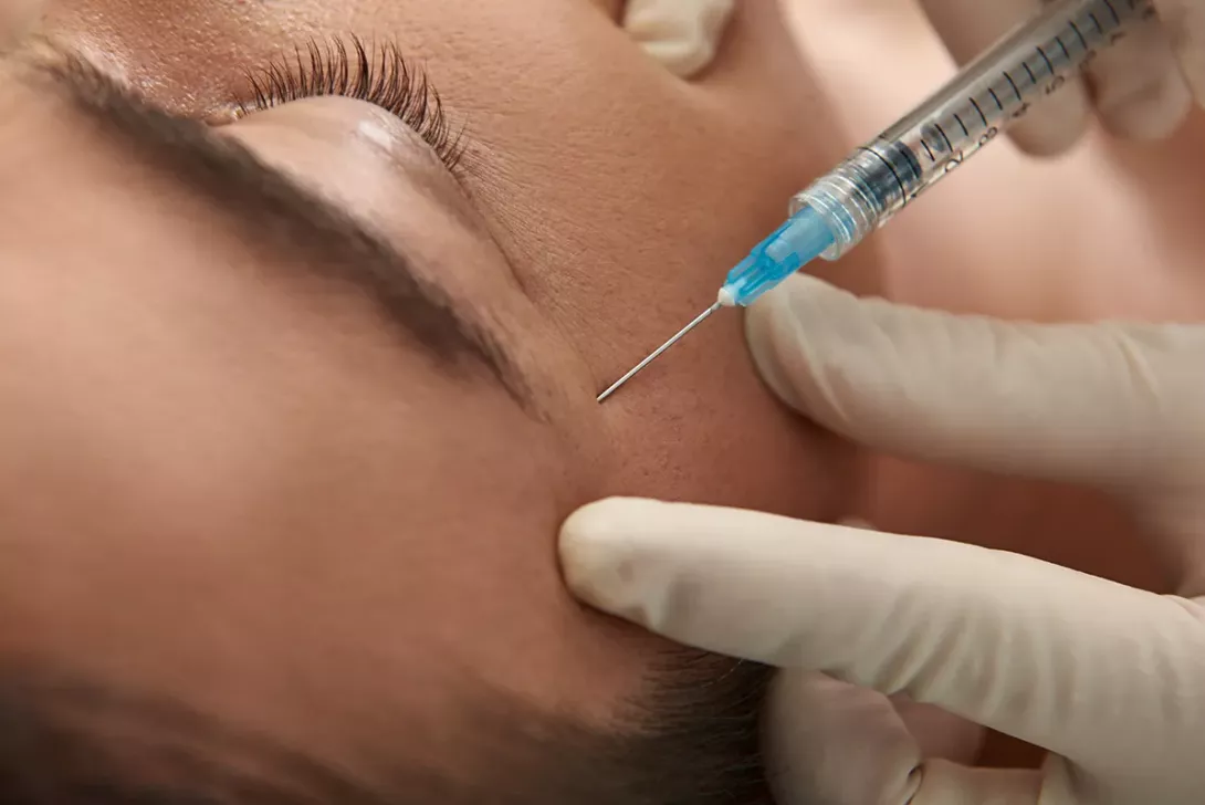 Traitement patte d’oie médecine esthétique : quelles solutions pour lisser le regard ?